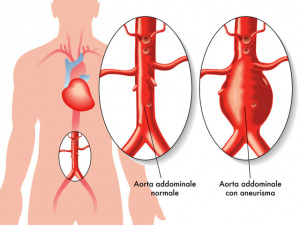 Aneurismi all'aorta addominale, arriva lo stent 3D su misura
