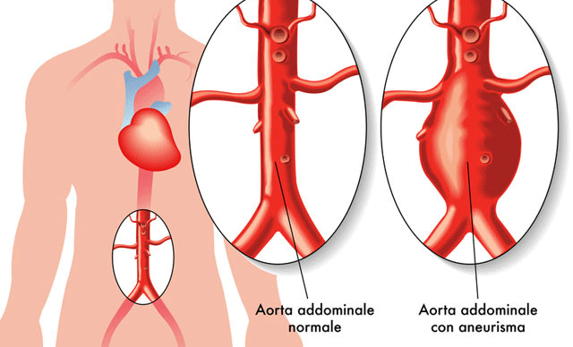 Aneurismi all'aorta addominale, arriva lo stent 3D su misura