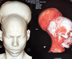 India: rimosso tumore al cervello da 1,87 kg, il più grande al mondo