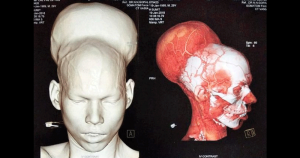 India: rimosso tumore al cervello da 1,87 kg, il più grande al mondo